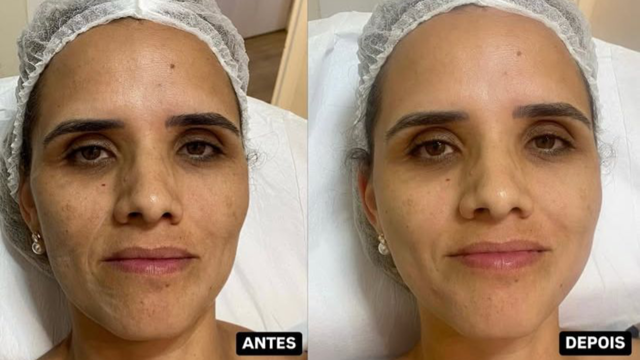 Antes e depois de Botox em terço superior