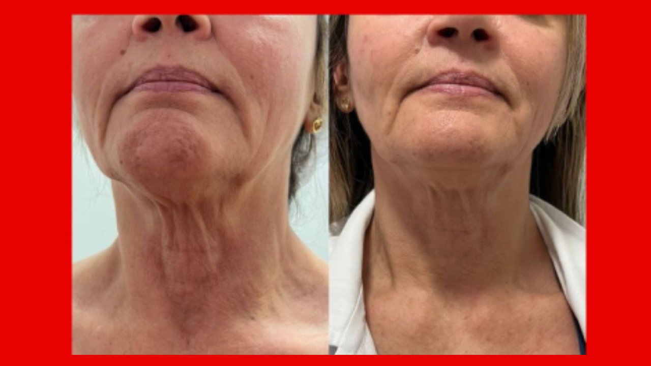 Antes e depois de bioestimulador de colágeno