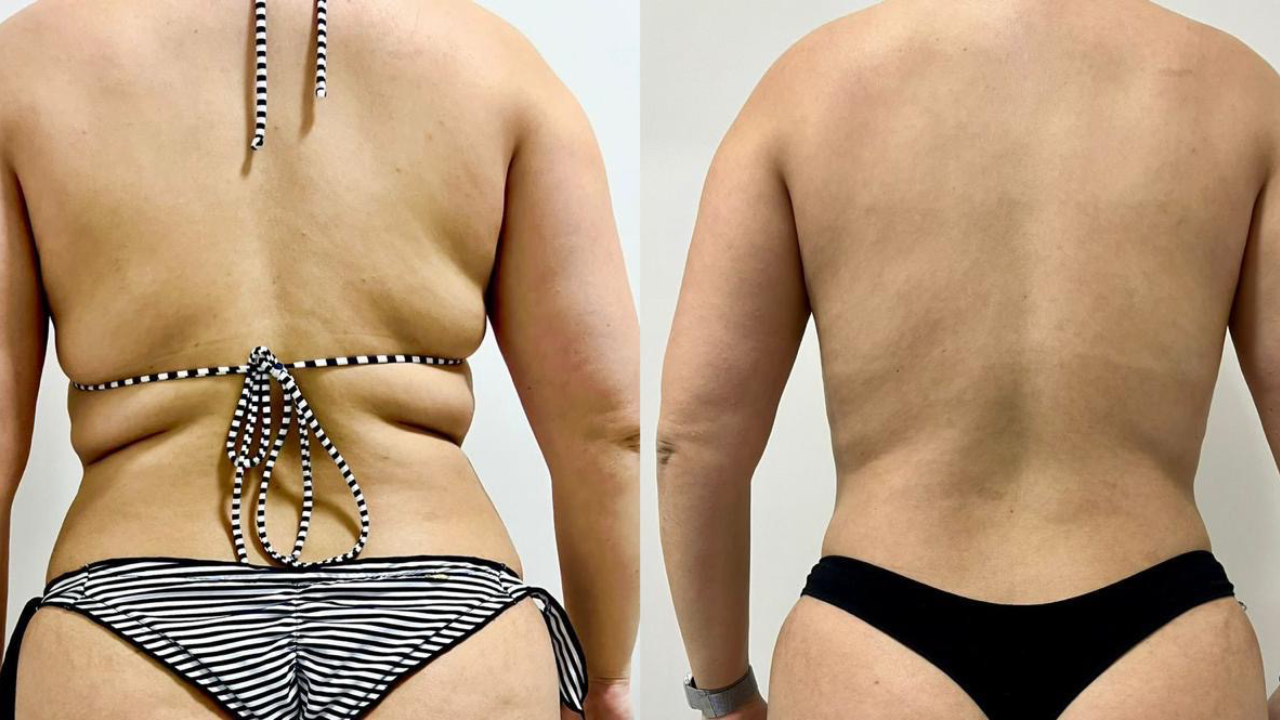 Antes e depois de protocolo para gordura localizada